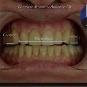 Biting And New Complete Dentures The Sandwich Filling Blog 71 Denture Occlusion In CR