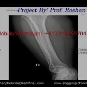 Bone Fracture Detection Using Python Opencv Bone Fracture Detection Using Deep Learning Project