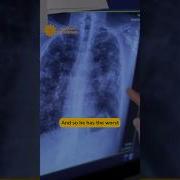 Heightened Silica Dust Exposure May Be Causing Black Lung In Miners At An Earlier Age Shorts
