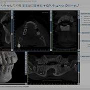 BSPV4 11 Virtually Extracting Teeth From 3D CT Scan