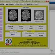 Types Of Brain Tumor Detection And Classification Using Matlab Project Code Brain Tumor Prediction