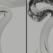 Vortex Cores In A Carotid Artery Siphon