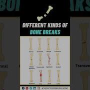 Types Of Bone Fractures Explained Simple Guide For Med Students Doctors