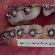Ligation Method For OBRACE Bracket 2 To Ligate With Ligature