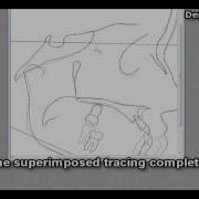 The Software FACAD Superimpose 2 Tracings 8 9