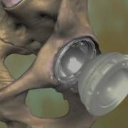 Total Hip Replacement