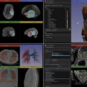 Automatic Multi Modality AI Medical Image Segmentation In 3D Slicer Using MONAIAuto3DSeg Extension