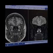 High Resolution And High SNR 3D MRI Using AIR Recon DL HyperSense3D BRAVO 2 27s3D Cube FLAIR