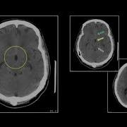 Neuroradiology Infections Interesting Radiology Cases