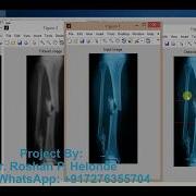Bone Fracture Detection Using Matlab Project With Source Code Bone Fracture Prediction