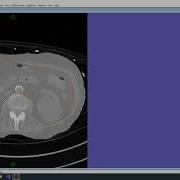 CT Abdominal Fat Segmentation Using FireVoxel With MagTrace