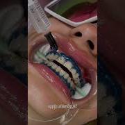 Teeth Whitening Process Teethwhitening Teethwhiteningprocedure