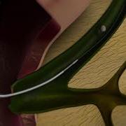 VOID Cleveland Clinic AD ERCP Medical Animation