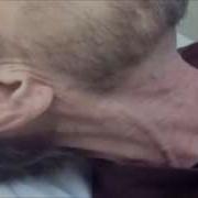 Расширение яремных вен ЯВВ Доктор Рифаи Виртуальный нефролог
