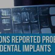 Dental Implants Expert Debunks Wild Claims Millions Reported Problems With Dental Implants