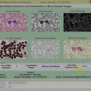 Malaria Parasite Detection And Classification In Blood Sample Images Using Matlab Project Code