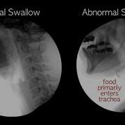 Normal Vs Abnormal Swallowing