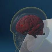 What Is Subdural Hematoma Scientific Animation