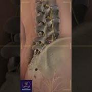 Spine Surgery Herniated Disk CT Scan Shorts Education