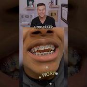 Is This The FASTEST Way To Get Braces