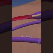 Wondering What Happens To Your Veins After Vein Treatment