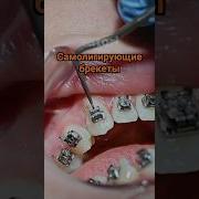 Самолигирующие металлические брекеты брекеты исправлениеприкуса самара