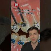 Putting Braces On Step By Step