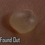 What Causes Blisters