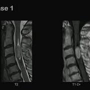 Identifying Pediatric Spinal Ependymoma Clues From A Case Review