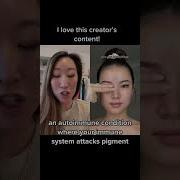 Vitiligo Is An Autoimmunedisease That Attacks Pigment In Your Skin Dermbypark
