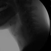 Swallow Study Thin Liquid Modified Barium Swallow Study MBSS Lateral View HD