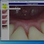 How To Install ProDENT Intraoral Camera And Capture Button Software For Apteryx