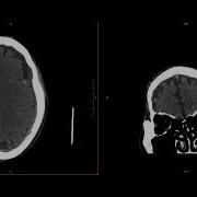 Neuroradiology Call Prep Cases Acute Subdural Hematoma CT Case 6 Discussion