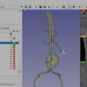 Vessel Segmentation And Centerline Extraction Using 3D Slicer And VMTK