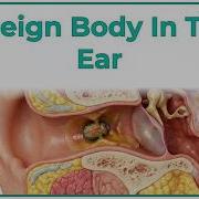 Foreign Body In The Ear ENT Lectures