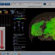BrainAvatar BrainDX SLORETA Z Scores