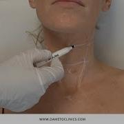 Profhilo Bio Aesthetic Points BAP Neck Technique Explained By Dr Gabriel Siquier
