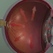Animation Glaucoma