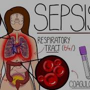 Understanding Sepsis Sepsis Explained Clearly