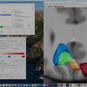 Lead DBS Walkthrough Tutorial Showing Sweetspot Fiber Filtering Network Mapping Explorers