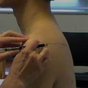 Surface Anatomy Acromion Process