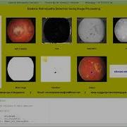 Diabetic Retinopathy Identification Using Matlab Code Image Processing Project With Source Code