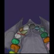 Management Of Impacted Canine With AI Segmentation Fusion And Simulation