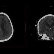 Neuroradiology Call Prep Cases Acute Subdural Hematoma CT Case 8 Discussion
