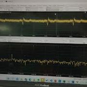 Experiment 3A Input Test ECG Signal To Instrumentation Amplifier With Filter