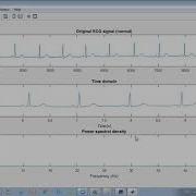 Signal Processing Matlab How To Import Raw ECG Data From Physionet Database