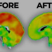 Long Term Effects Of Antidepressants On The Brain
