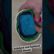 В чём разница между субдуральным и эпидуральным кровотечением фельдшер студентфельдшера студе