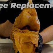 Is KNEE REPLACEMENT The MOST PAINFUL Surgery Ever