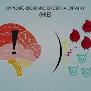 Hypoxic Ischemic Encephalopathy About Treatments Causes